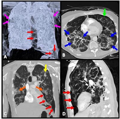 Bilateral Spontaneous Pneumothorax in a COVID-19 and HIV-Positive Patient: A Case Report